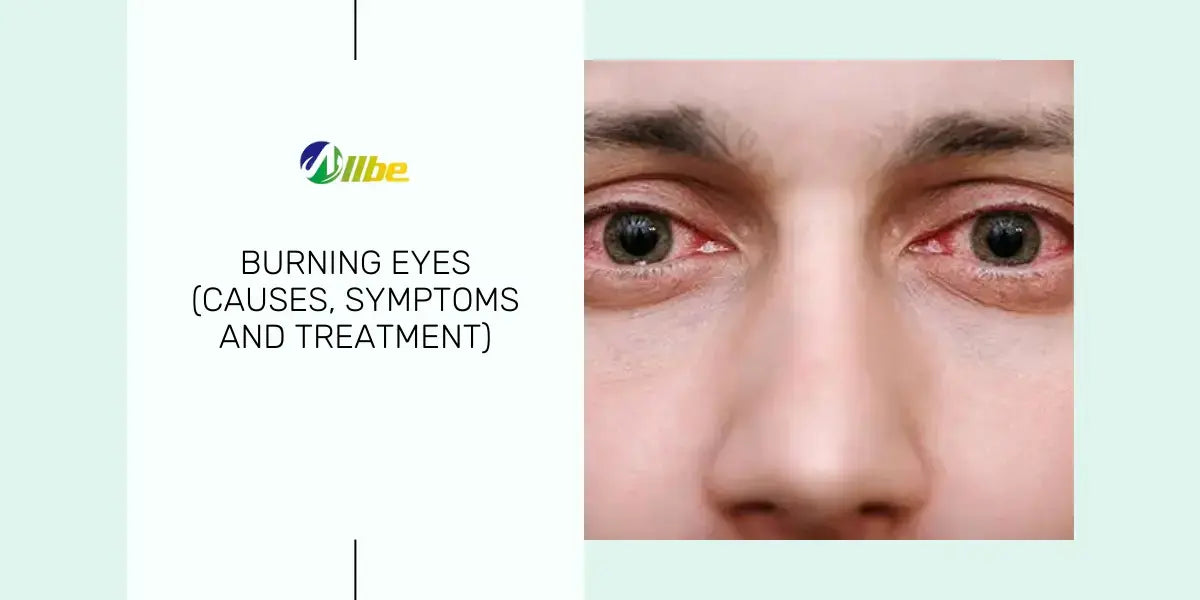 Burning Eyes Causes Symptoms and Treatment Allbe Canada